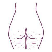 Redução de Celulite e Flacidez